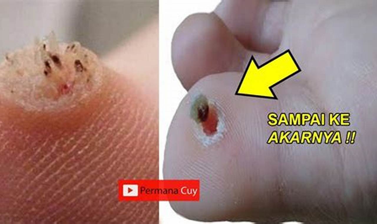 Cara Mengatasi Mata Ikan Dengan Mudah Dan Efektif